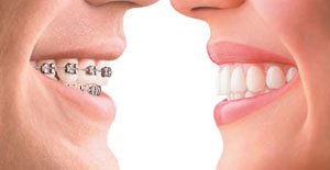 braces braces