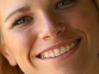ceramic-braces-picture ceramic-braces-picture