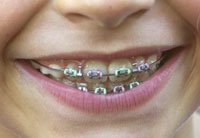 metalBraces metalBraces