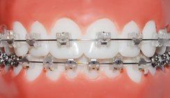 self-ligating-clear-braces self-ligating-clear-braces